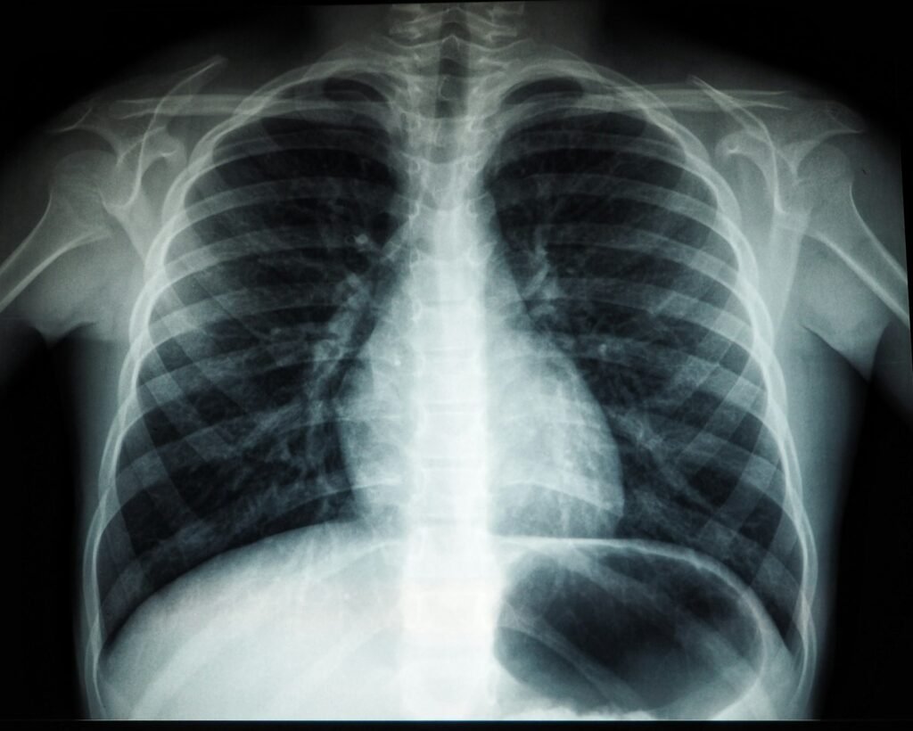 Chest X-ray showing the rib cage, lungs and heart, the kind of imaging used to find a broken catheter