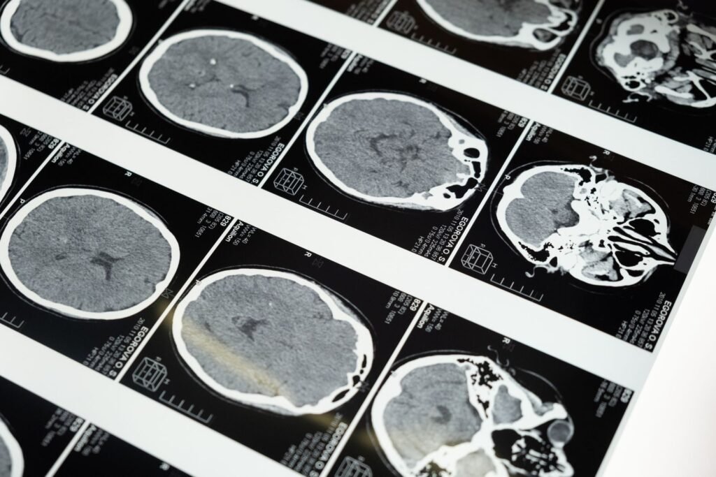 Brain MRI scans on a lightbox, the kind of imaging used to confirm a meningioma in a Depo-Provera lawsuit