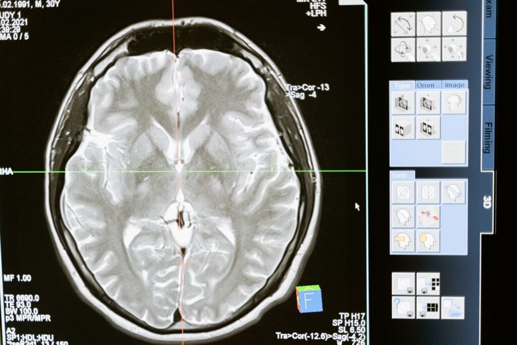 Detailed MRI brain scan displayed on a computer monitor