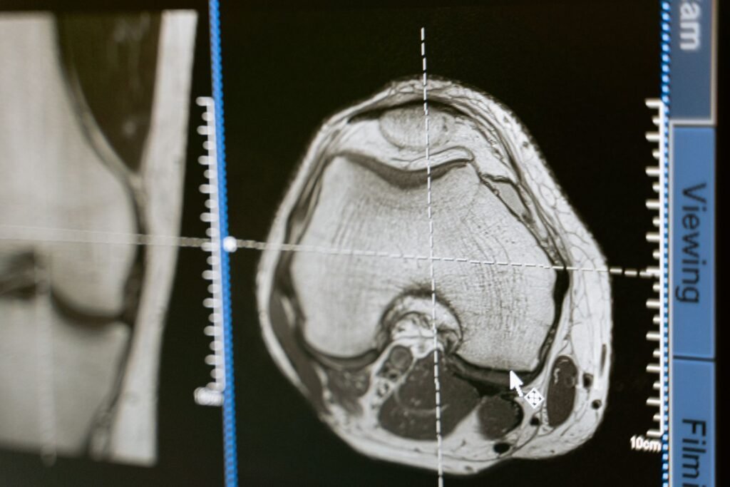 MRI brain scan on a medical monitor, the kind of imaging record used in a Depo-Provera lawsuit